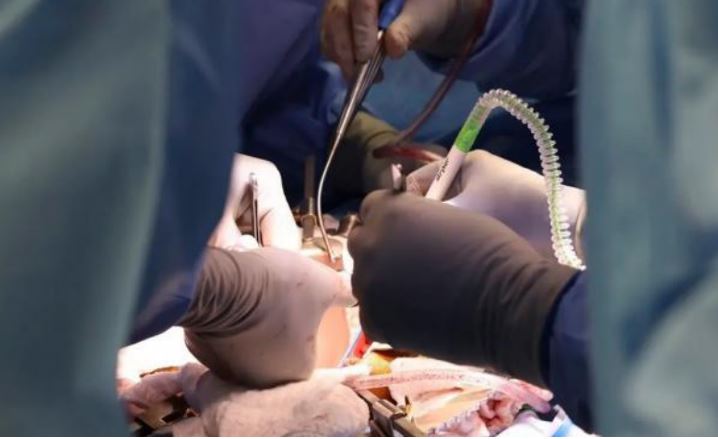 پیوند کلیه خوک به انسان