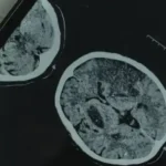 تاثیر منفی گرایی بر مغز